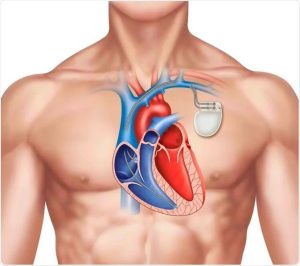 Read more about the article CÂT POȚI TRĂI CU STIMULATOR CARDIAC?