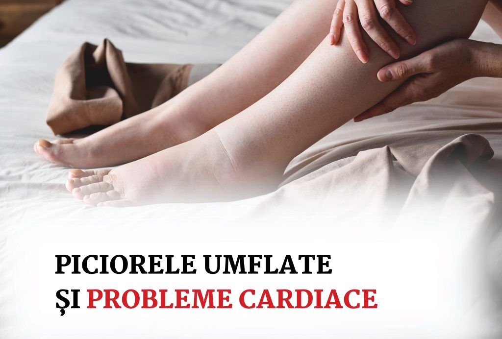 picioarele umflate