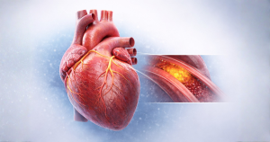 Read more about the article Boala coronariană silențioasă: cum o depistăm înainte de infarct